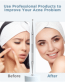 TAYTHI Bestope Blackhead Remover Pimple Acne Extractor Tool With Metal Case (Silver)
